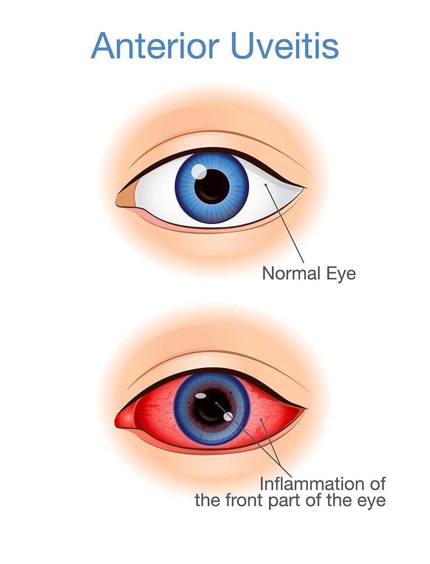 Uveitis Symptoms, Causes and Treatment