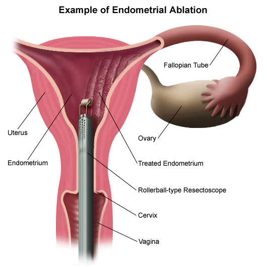 Endometrial Ablation NewtonWellesley Hospital