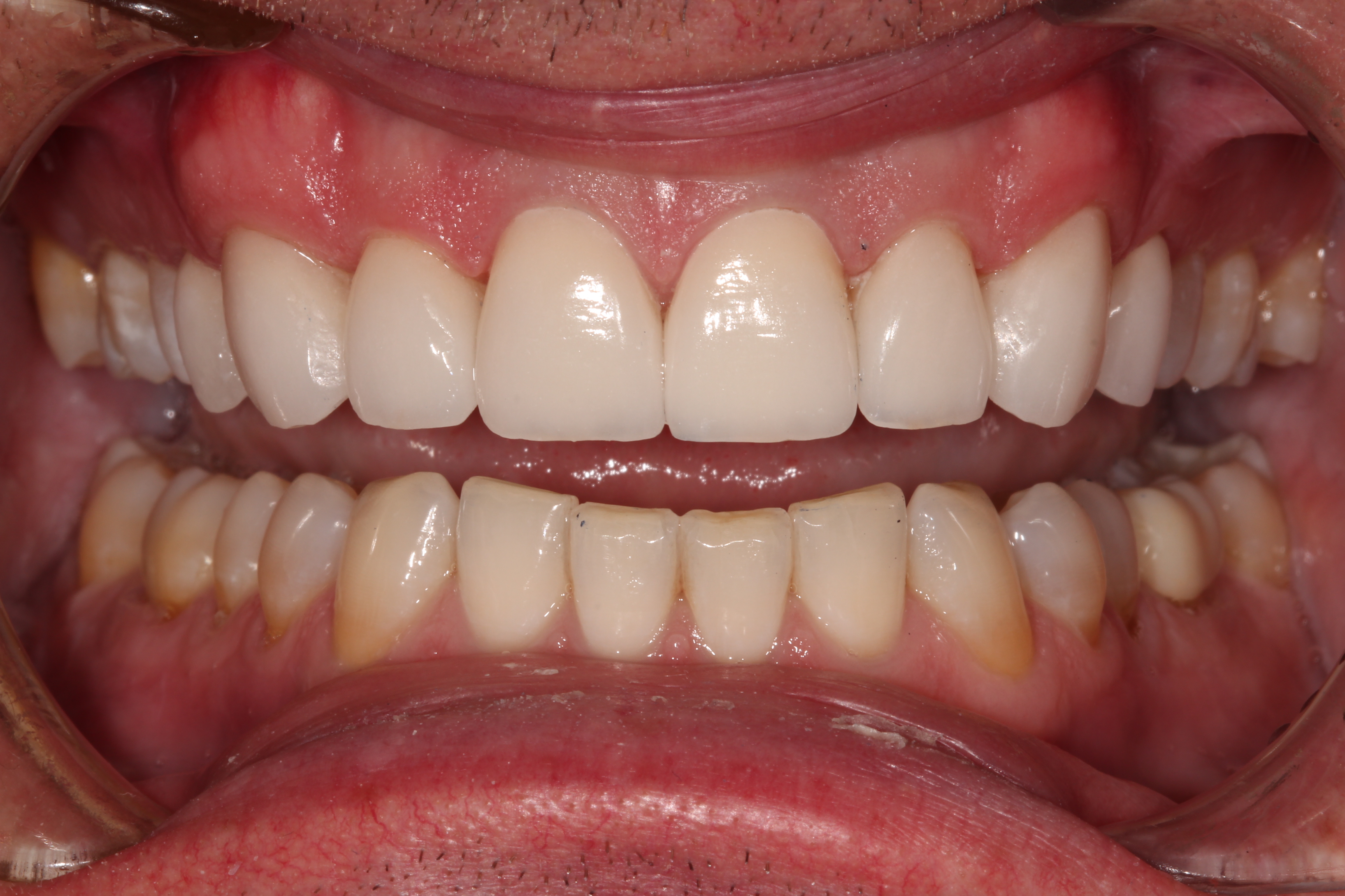 Porcelain Veneers in New York City Dental Services NYCCD