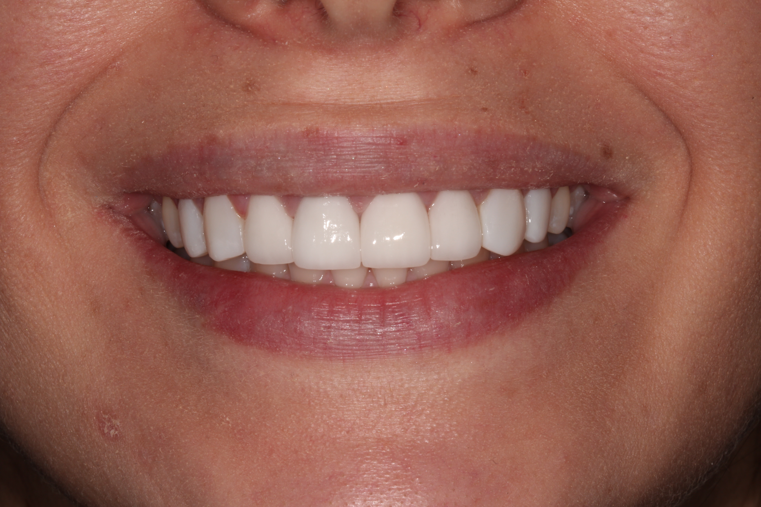 Porcelain Veneers in New York City Dental Services NYCCD