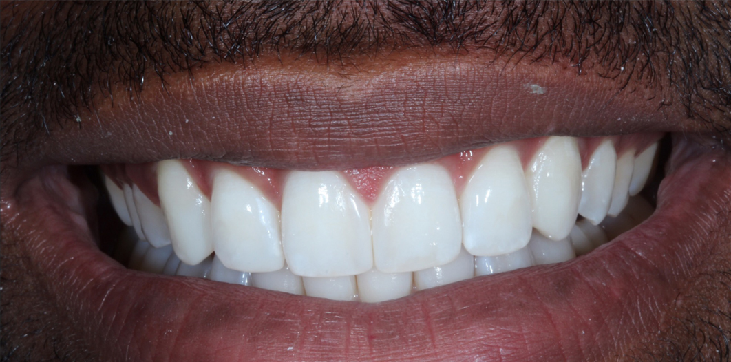 NYC Dental Bonding Top Cosmetic Dentist in Manhattan Dr. Layliev