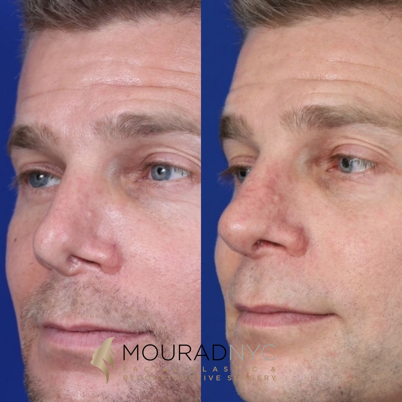 Male Revision Rhinoplasty Before and After Head and Neck Surgeon