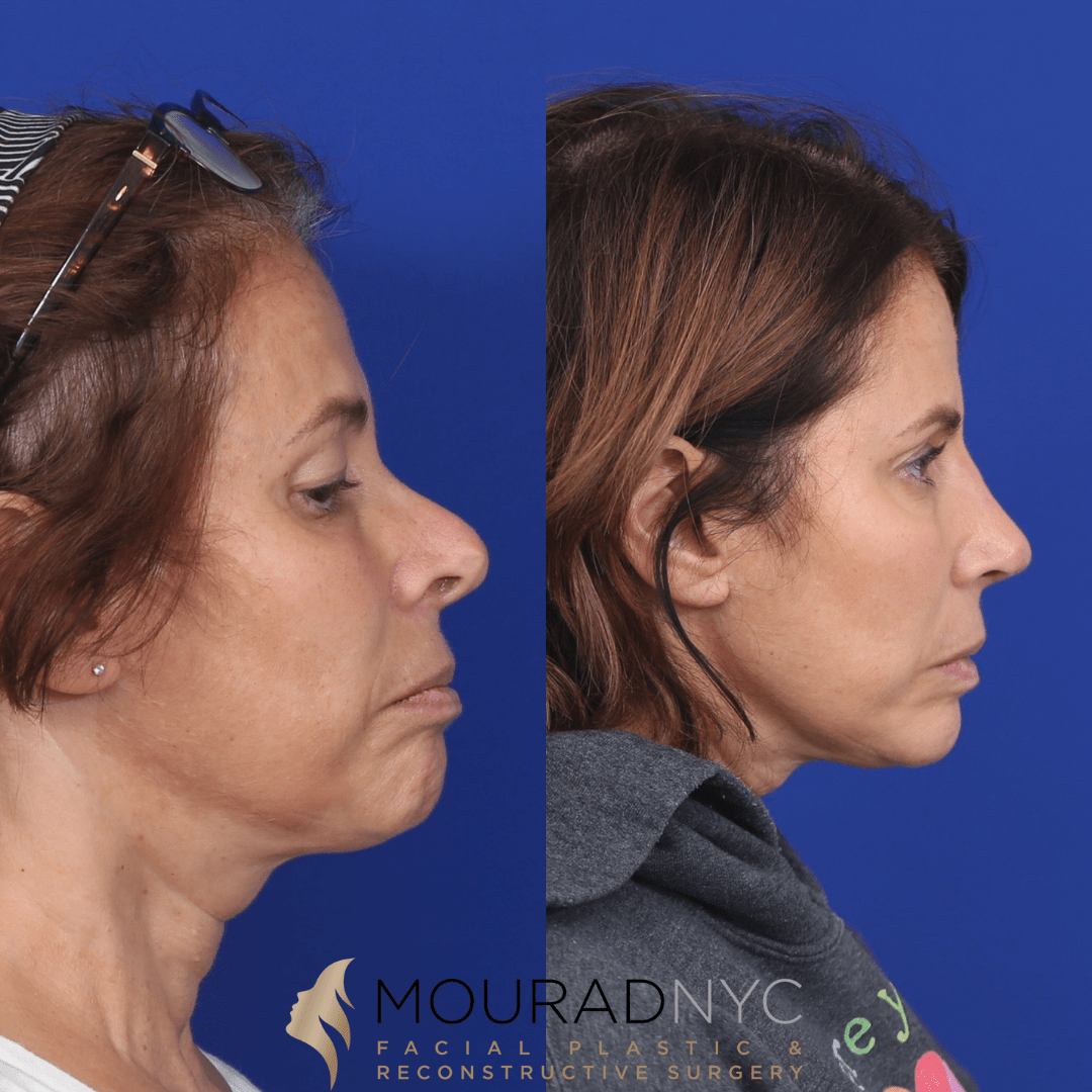 best plastic surgeons in michigan rhinoplasty Wonderful Evening