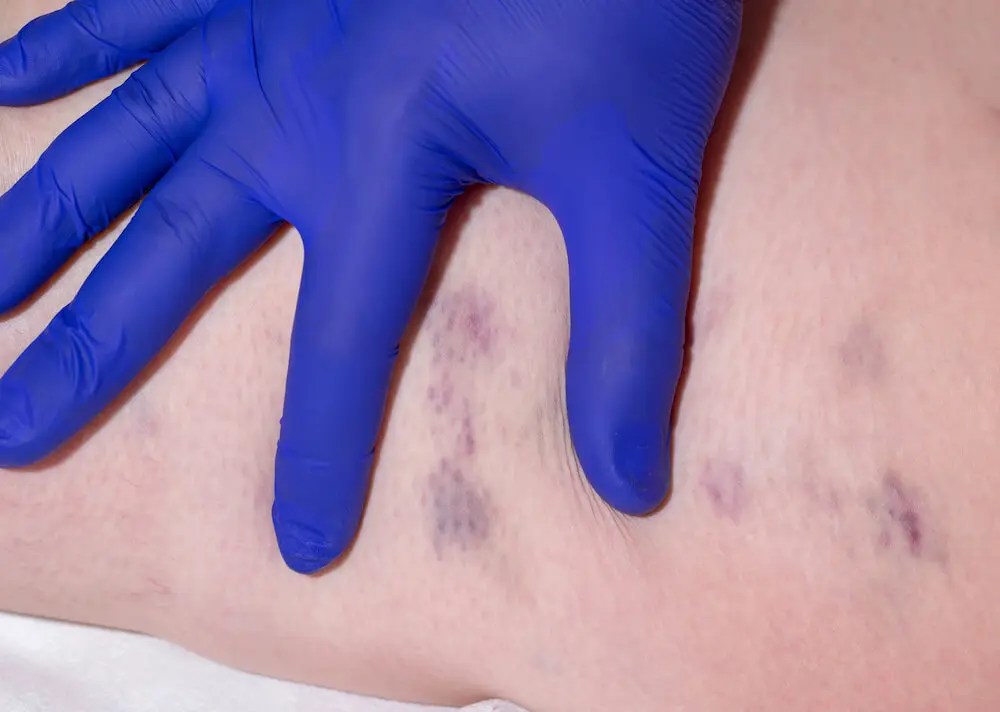 What Happens When a Vein Ruptures? NY Metro Vein