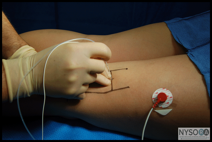 Popliteal Sciatic Nerve Blocks Intertendinous / Lateral Approach