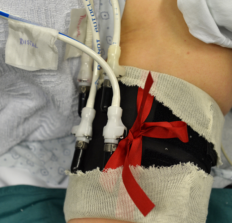 Bier Block NYSORA The New York School of Regional Anesthesia