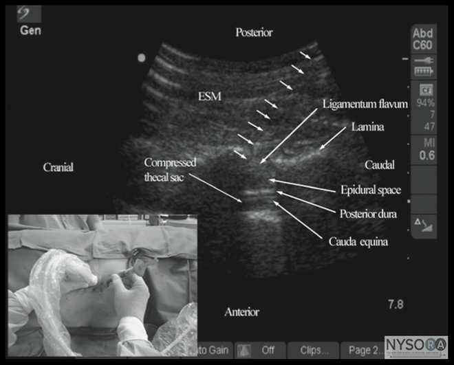 Spinal and Epidural Block NYSORA The New York School of Regional Anesthesia