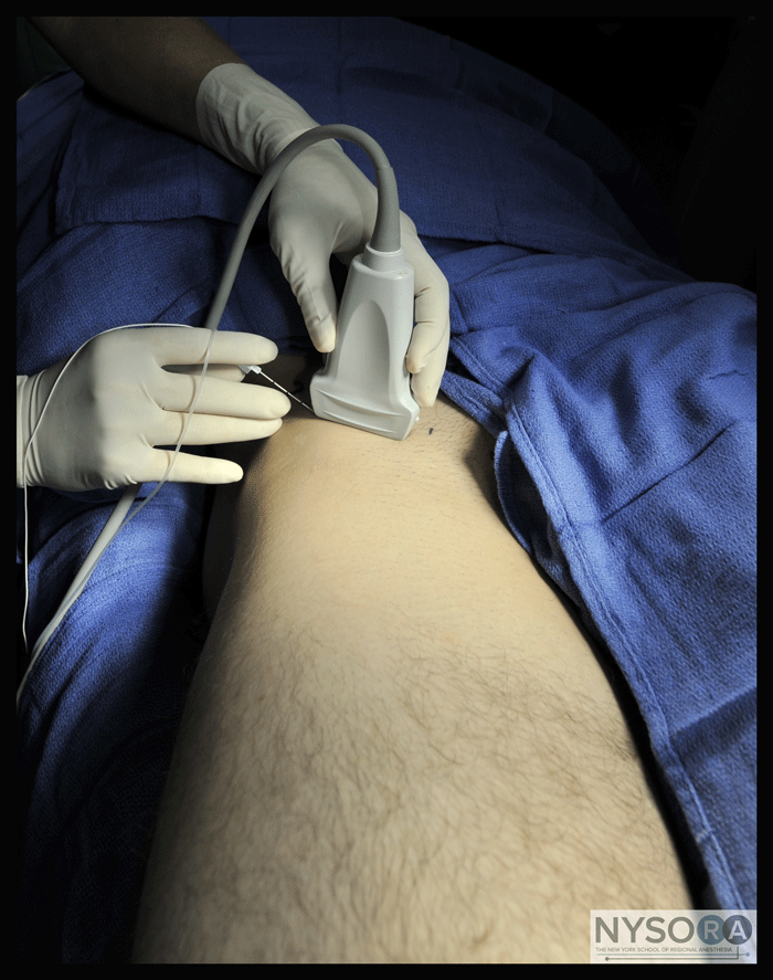 UltrasoundGuided Fascia Iliaca Block NYSORA The New
