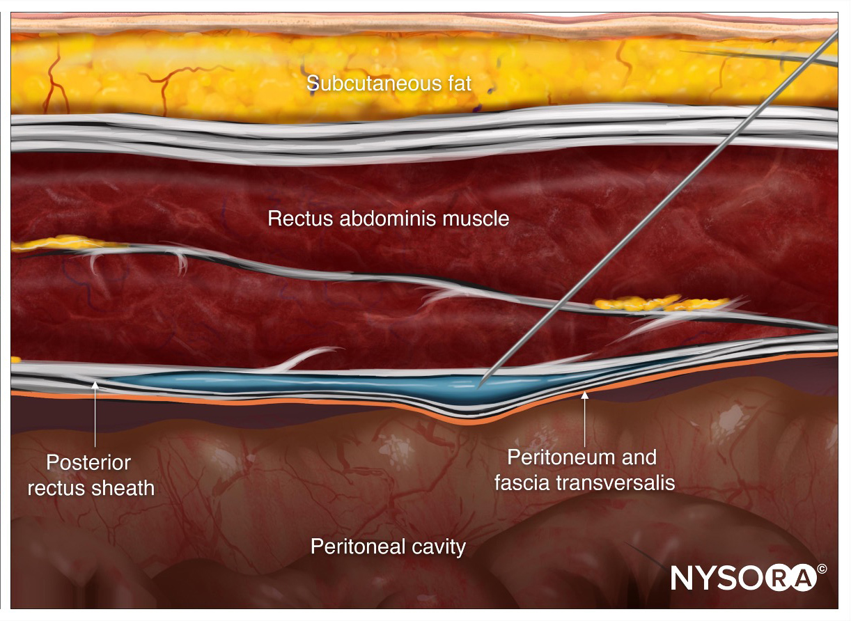 Truncal and Cutaneous Nerve Blocks NYSORA