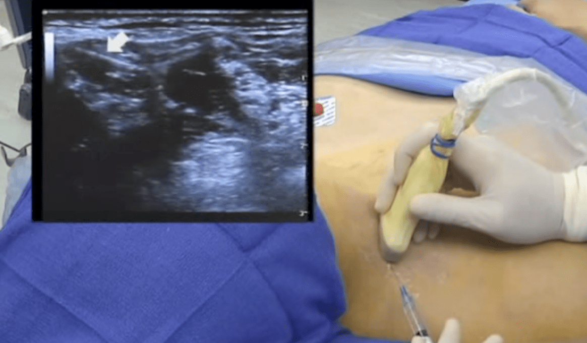 UltrasoundGuided Interscalene Brachial Plexus Block Video NYSORA The