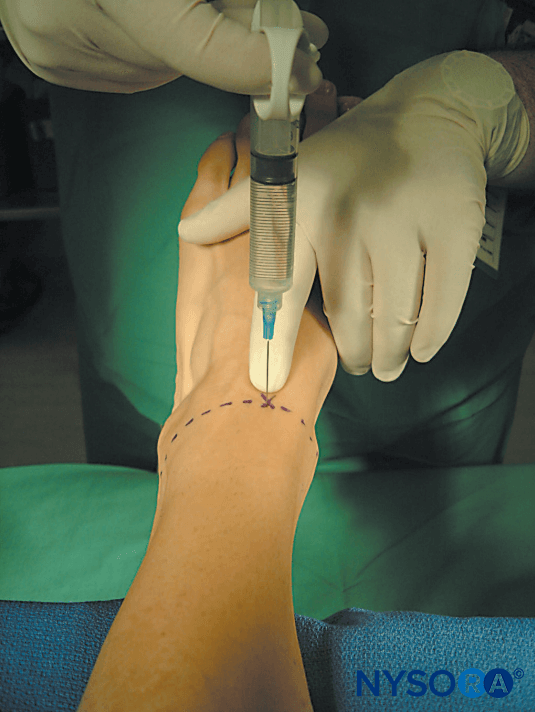 Ankle Block Landmarks and Nerve Stimulator Technique NYSORA
