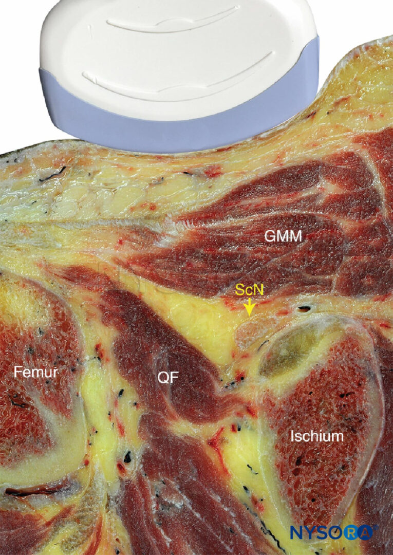 UltrasoundGuided Sciatic Nerve Block NYSORA