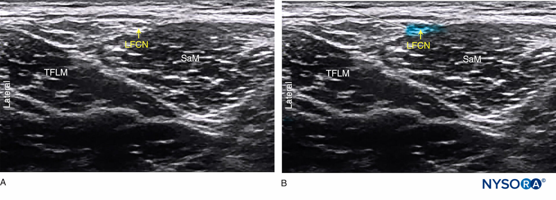 UltrasoundGuided Lateral Femoral Cutaneous Nerve Block NYSORA