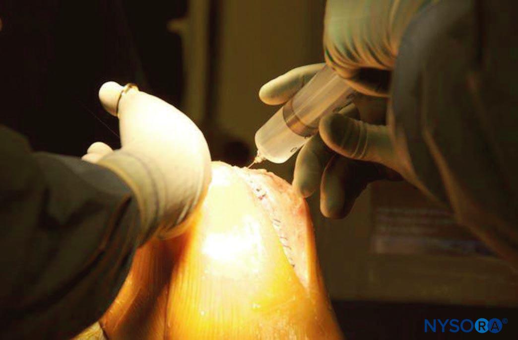 Intraarticular and Periarticular Infiltration of Local Anesthetics