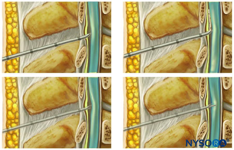 Combined SpinalEpidural Anesthesia NYSORA