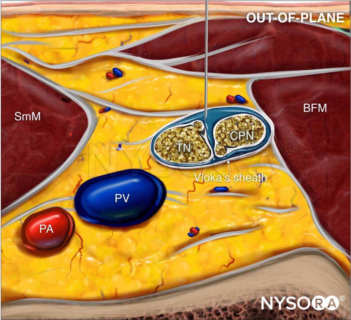 UltrasoundGuided Popliteal Sciatic Nerve Block NYSORA