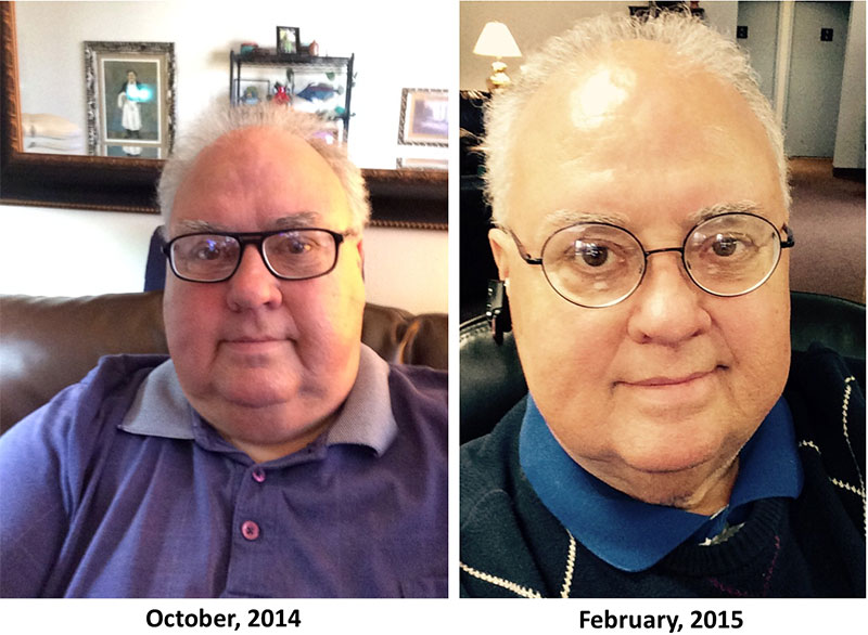 Bariatric Surgery At Age 65
