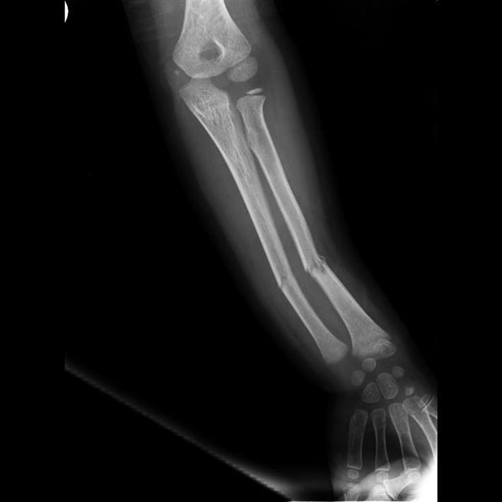How Long Does It Take A Greenstick Fracture To Heal Mediasi