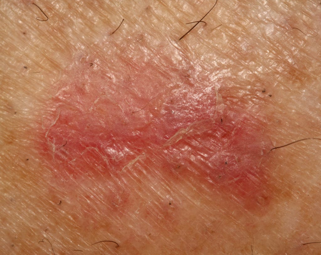Basal Cell Carcinoma Clinical Presentation and Management The ObG