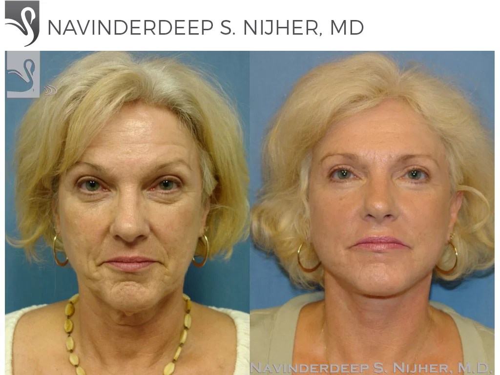 Face Lift 37215 Ocala Plastic Surgery
