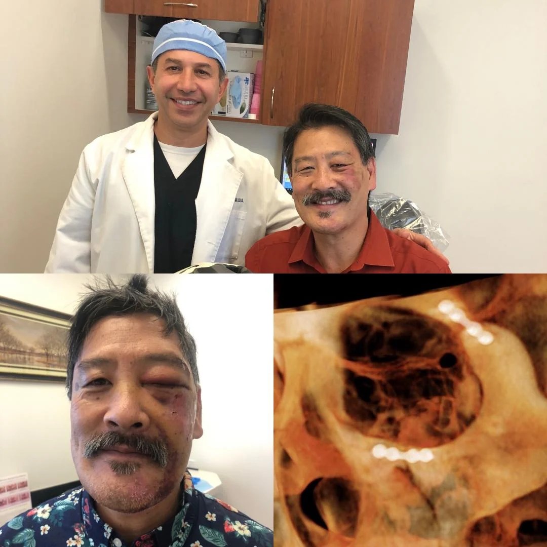 Cheek Bone (Zygoma) Fractures Rancho Santa Margarita CA, Orange County