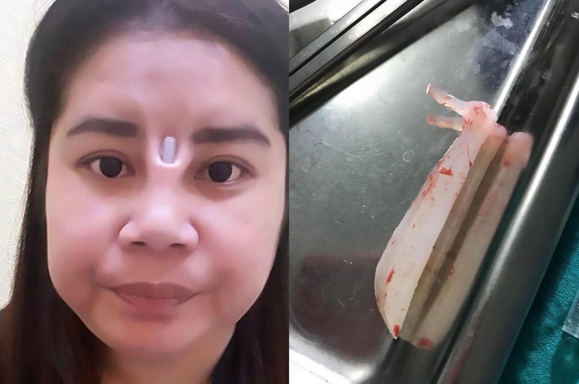 Botched Plastic Surgery Leaves Woman with Protruding