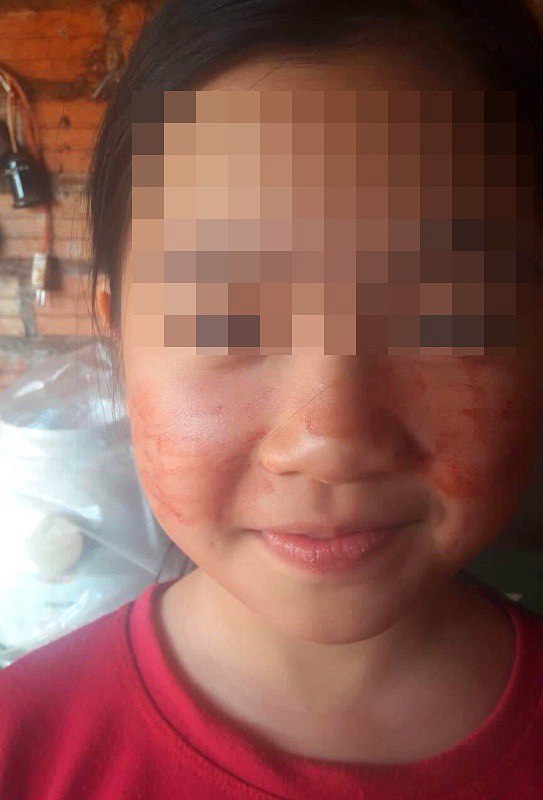 Sweating Blood Disease