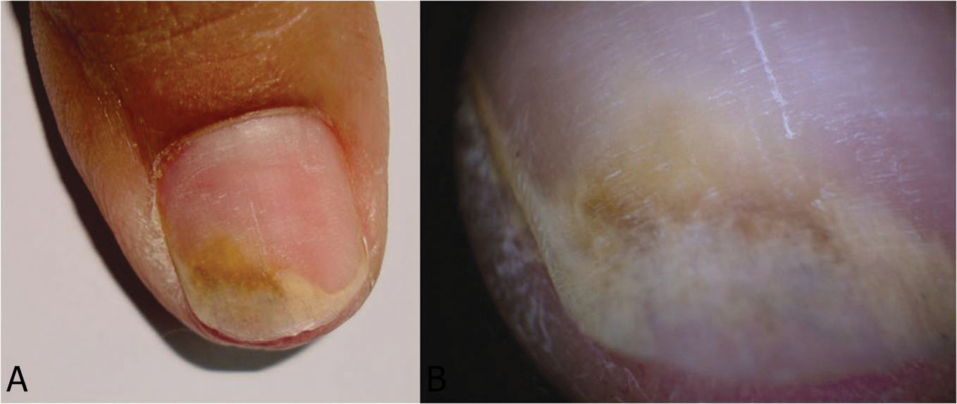 2014.225.Onycholysis Our Dermatology Online