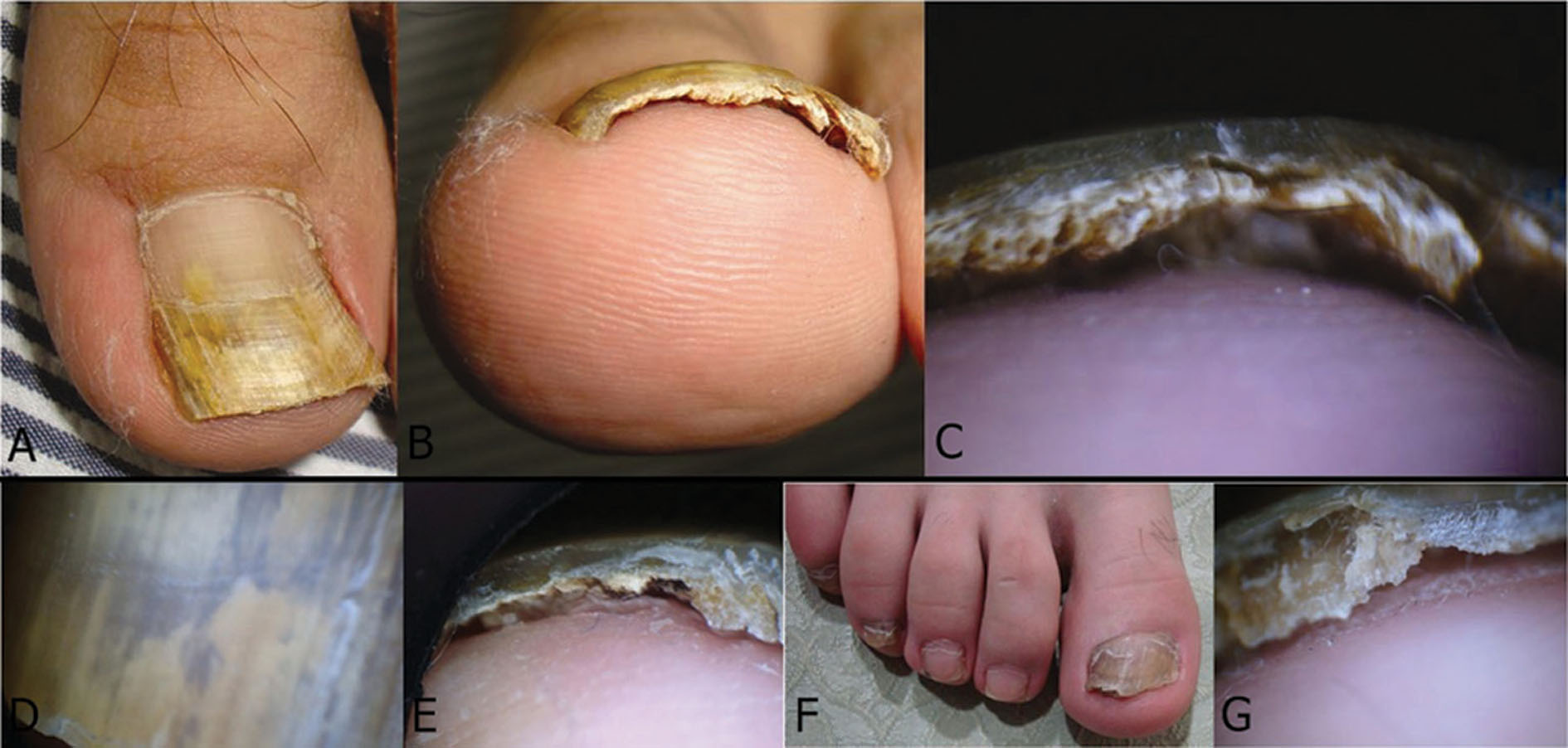2014.225.Onycholysis Our Dermatology Online