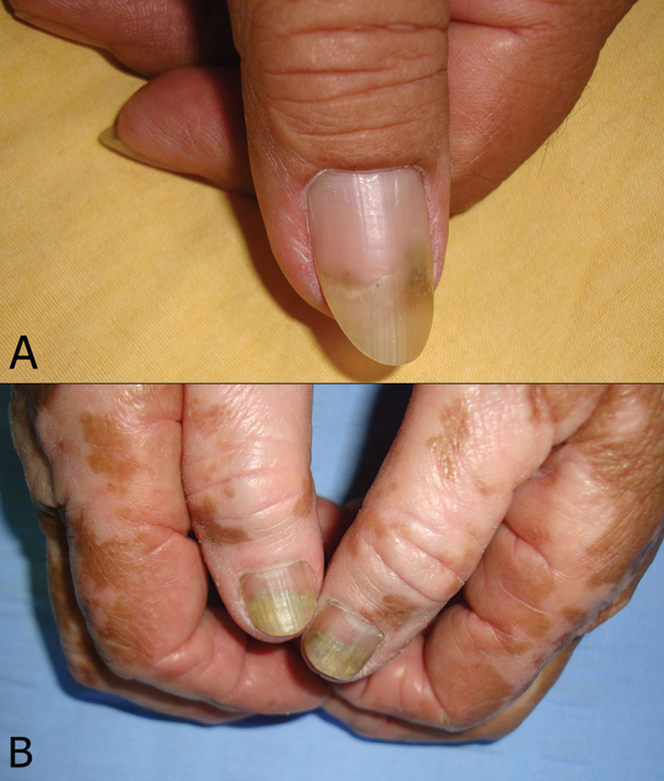 2014.225.Onycholysis Our Dermatology Online
