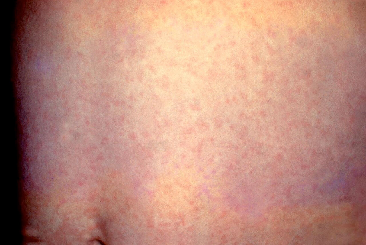 Dec 01, 2020 · die ursachen für schmerzende und geschwollene lymphknoten am hals, unter den armen oder an der leiste sind meist harmlos. Kinderkrankheiten Masern Scharlach Roteln Windpocken Co Oko Test