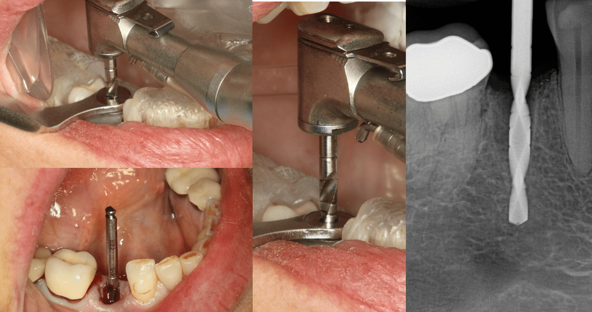 Comparing the Pilot Path to the Screw Access on an Emax Abutment Crown