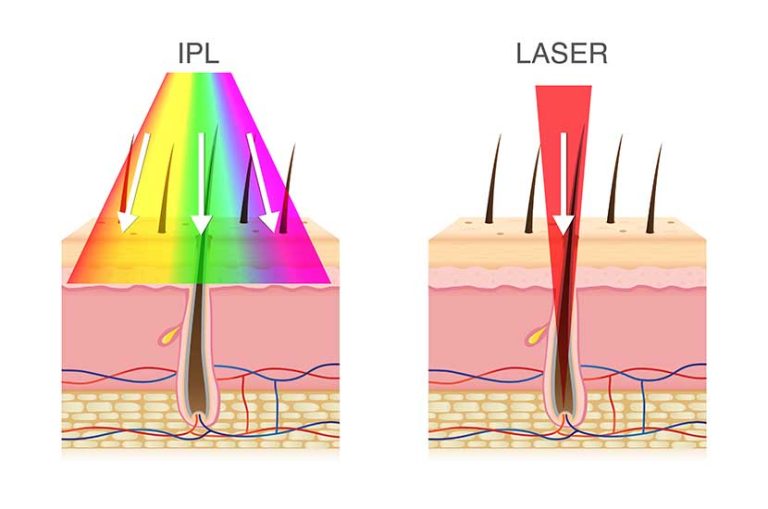 How Does IPL Laser Work? Uses, Benefits & Side Effects To Know In 2023