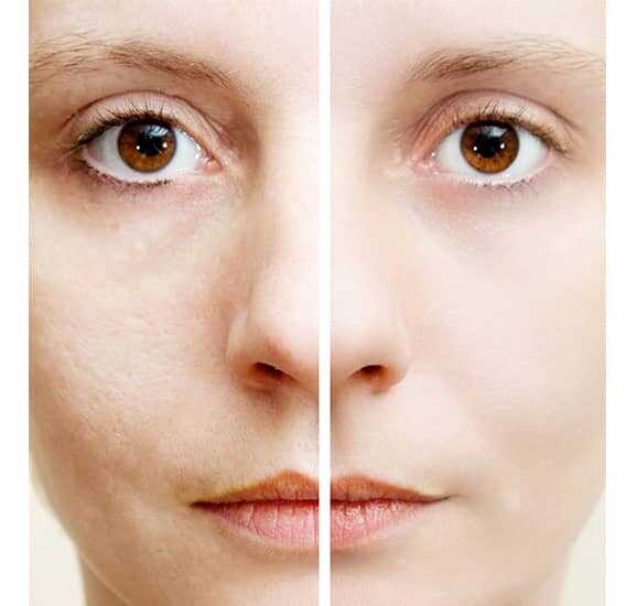 How You Can Benefit From Using Microdermabrasion To Eliminate Acne