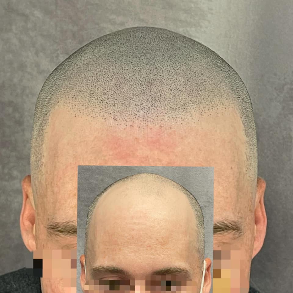Scalp Micropigmentation in Columbus, OH A Transformational Hair Loss Solution Ohio SMP Studio