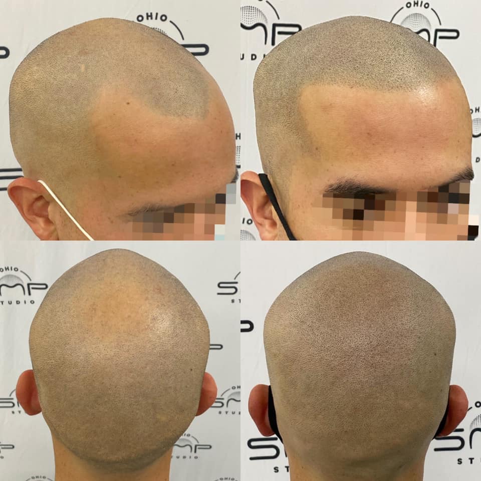 Unraveling the Myth Hats and Hair Loss Explained by Columbus SMP Artist