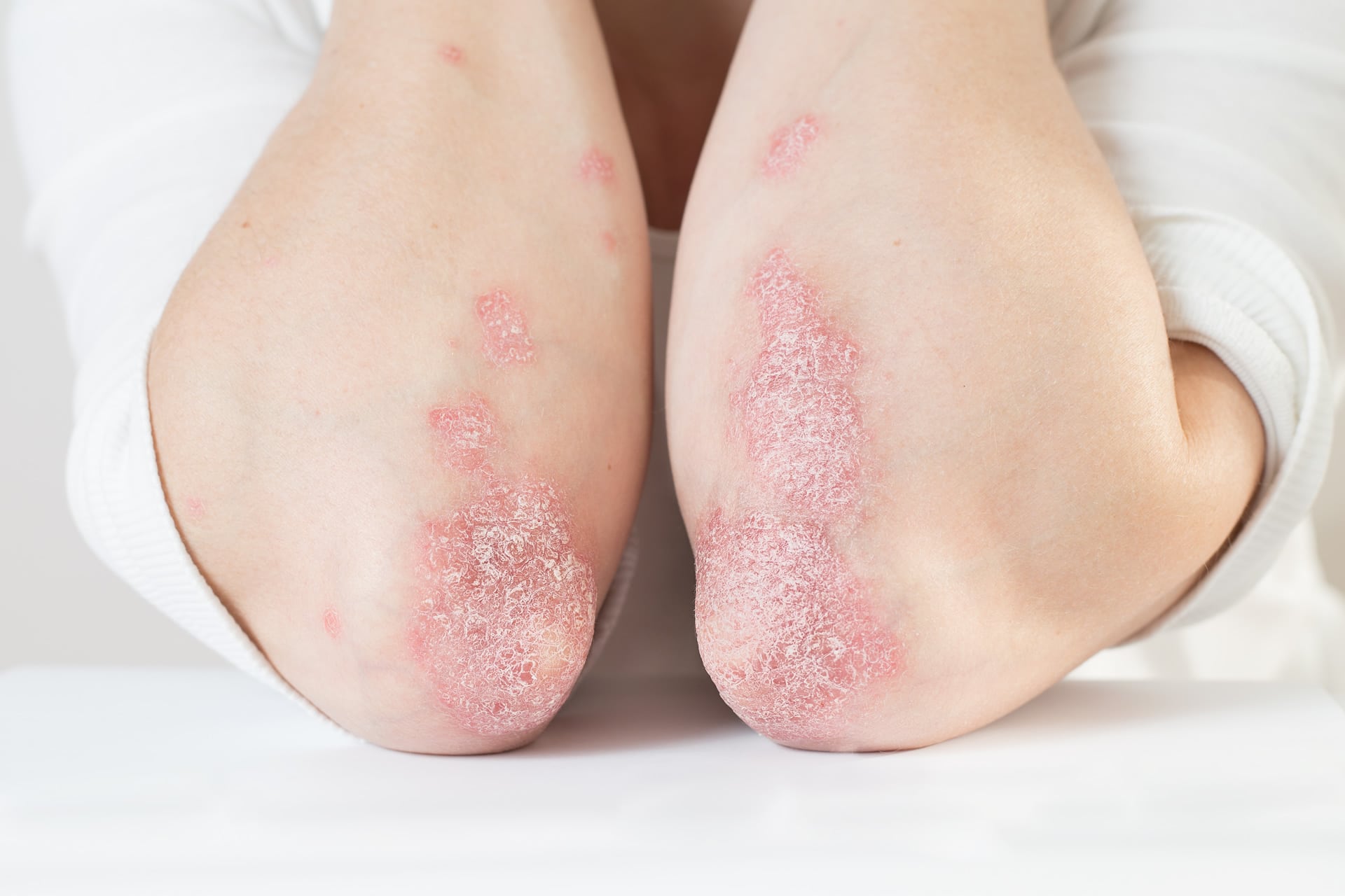 Is Psoriasis An Autoimmune Disease? Kicker