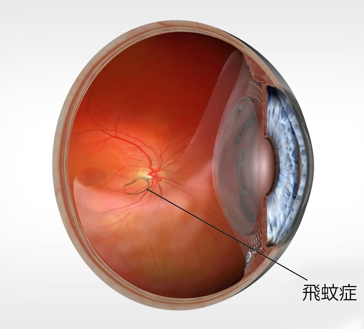 飛蚊症治療｜岡眼科クリニック