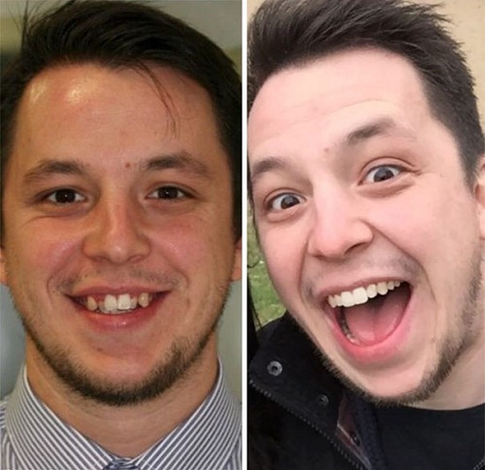 20 Personas que demuestran su cambio después de los brackets