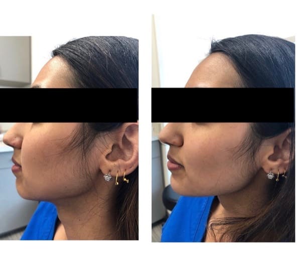Botox for Jawline Reshaping Olansky Dermatology & Aesthetics