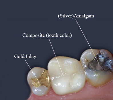 Fillings – Tooth colored composites | Old Hook Dental