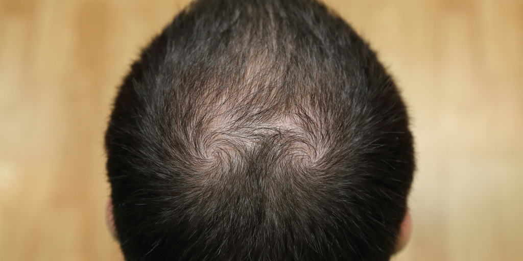 Tinea Capitis – Causes, Symptoms And Treatments