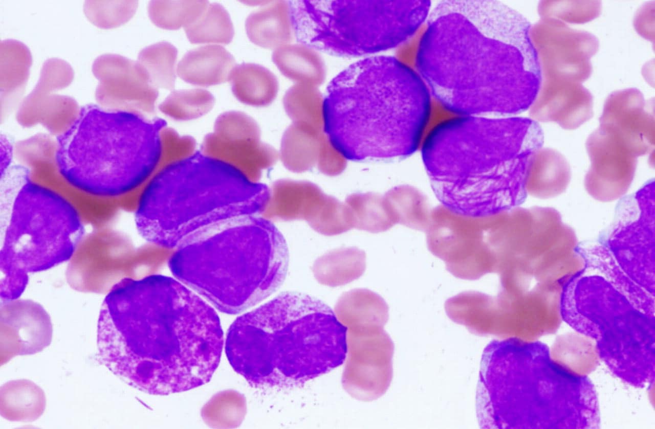 Acute Promyelocytic Leukemia UCLAOlive View Internal Medicine