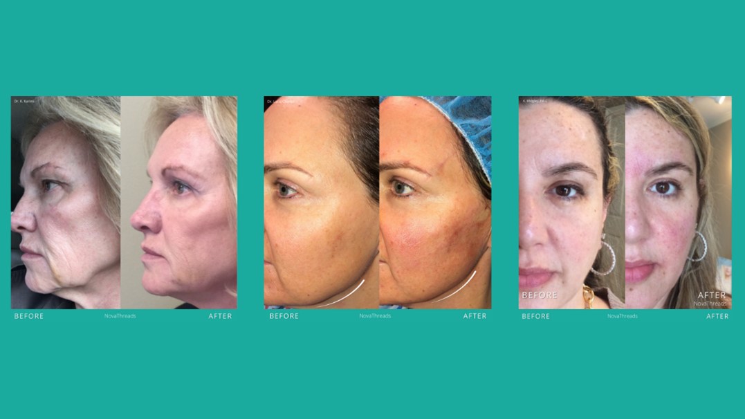 PDO Threads Optimal Medical Group Fresno, CA