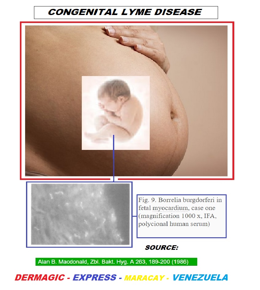 Lyme Disease And Pregnancy Complications Captions Imajinative