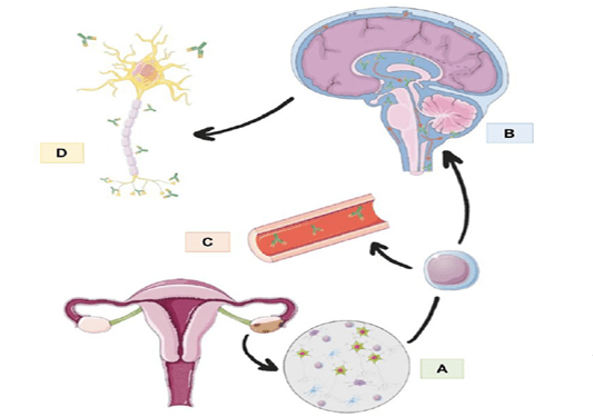 AntiNMDA receptor encephalitis associated to ovarian teratoma