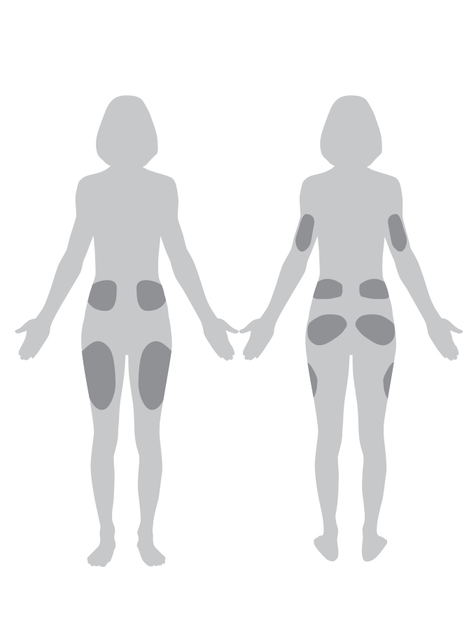 Pod Placement Guide Insulin Pump Therapy Omnipod