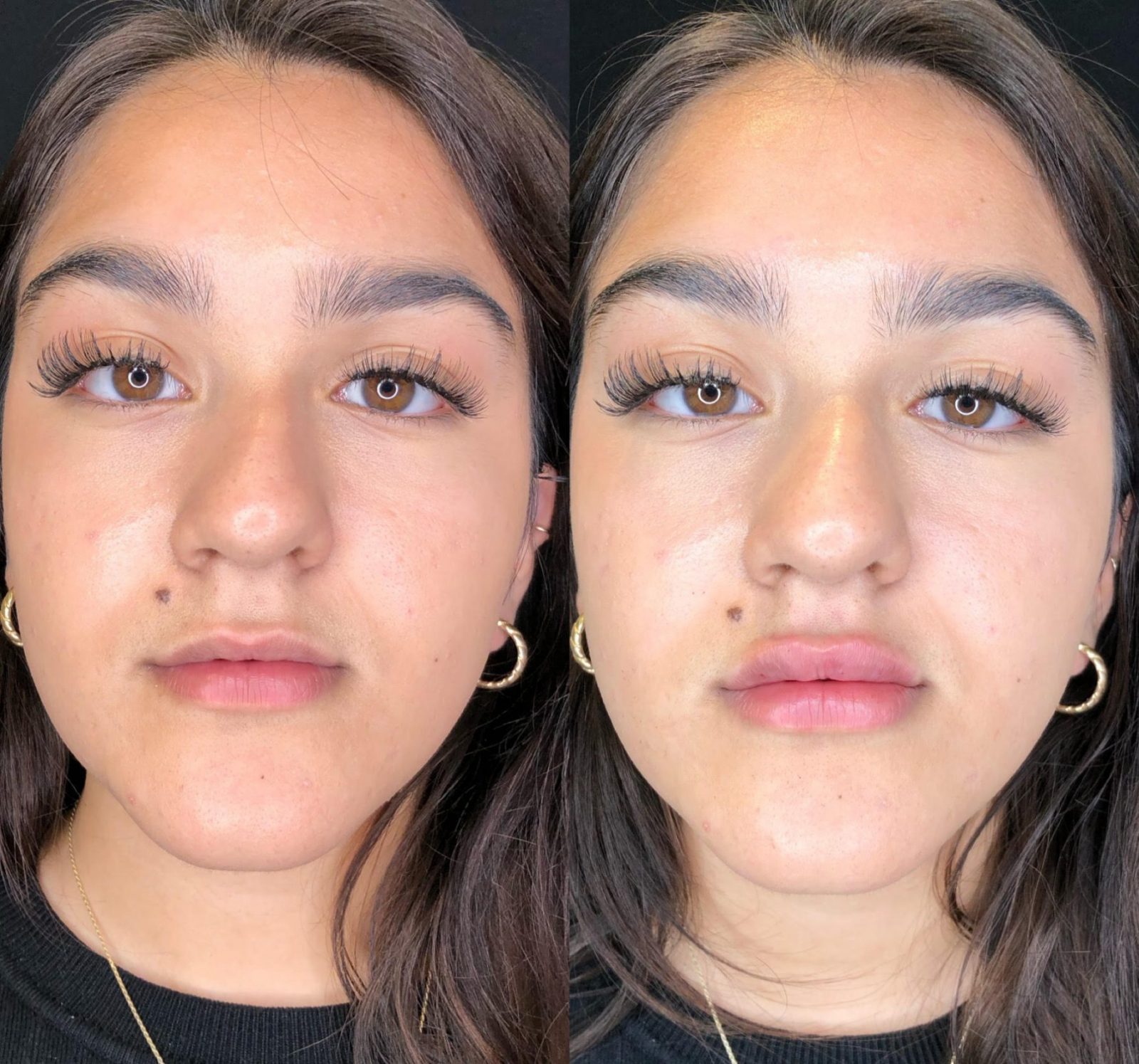 Before and After Lip Fillers Omniya Clinic London