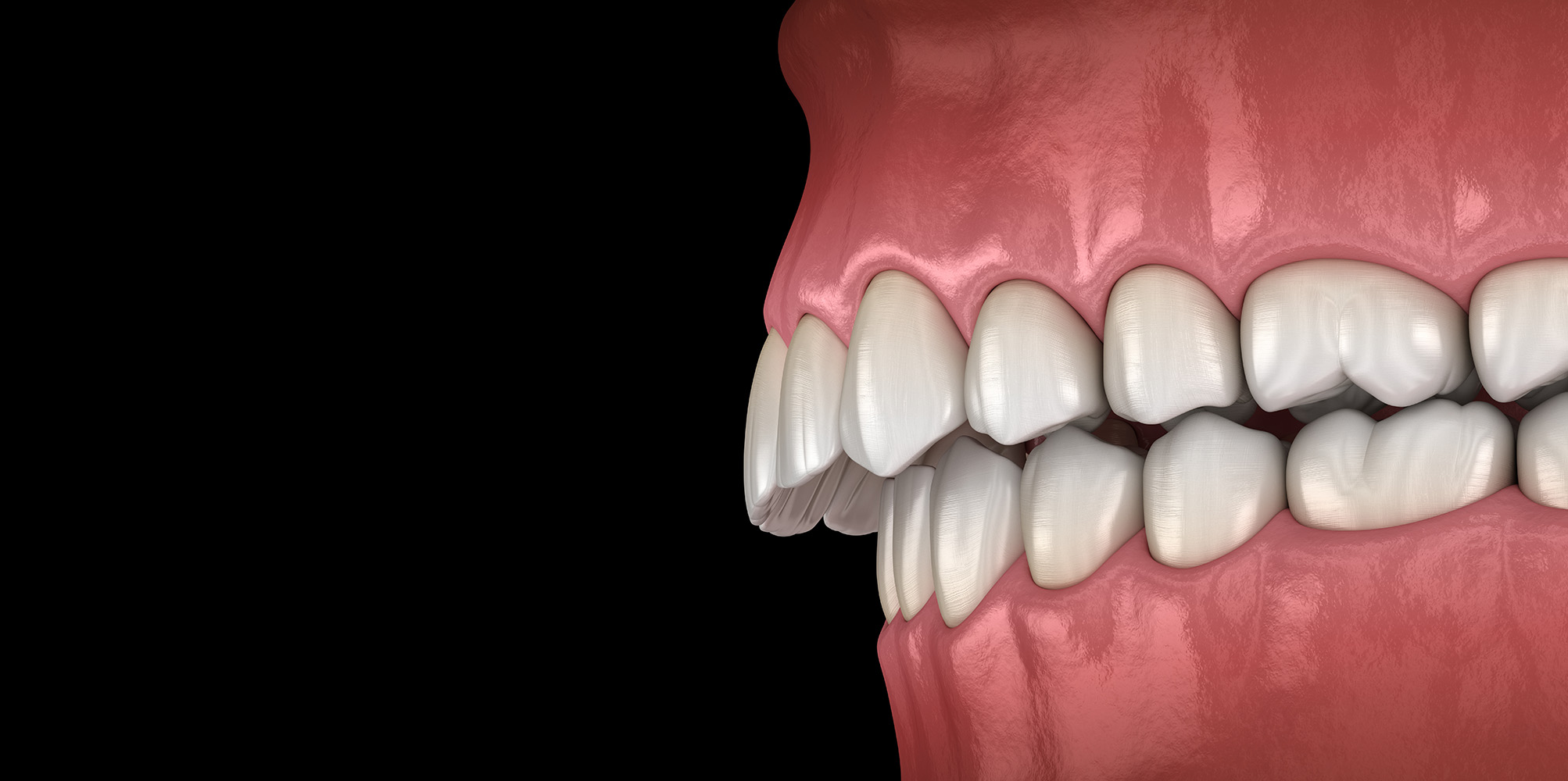 Overbite / Underbite Carbondale, IL Oral & Maxillofacial Surgery