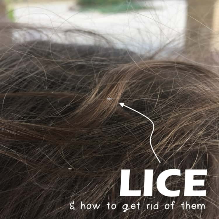 You've Got Lice Here's How to Get Rid of Lice, Without Shampoos